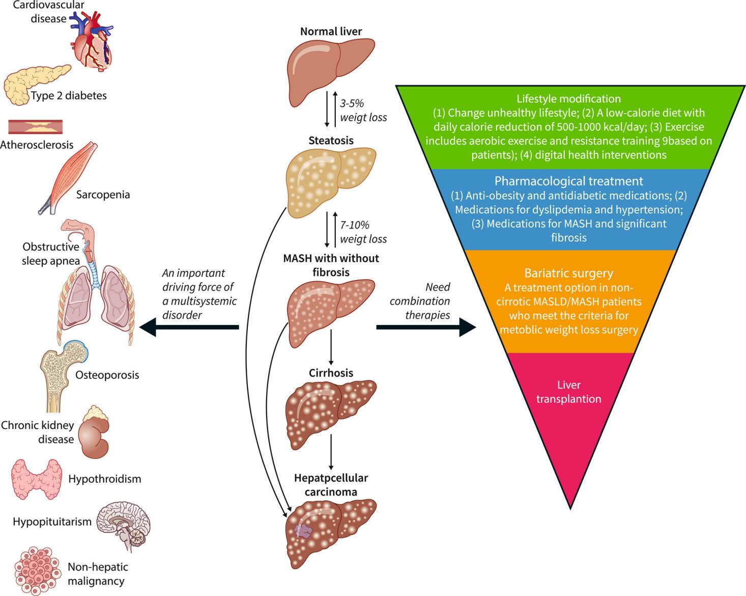 深度解析，MASH常用小鼠模型汇总