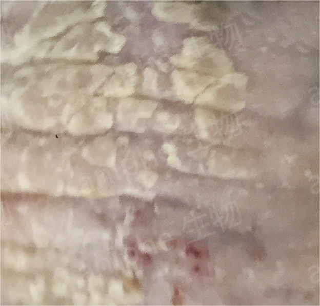 疾病模型|迁延不愈的银屑病模型构建方法