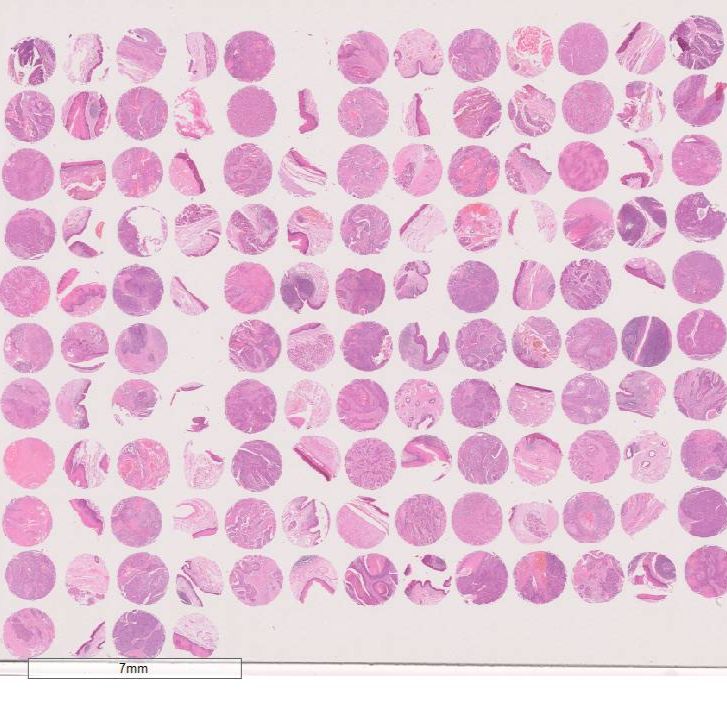 生存期喉癌组织芯片