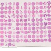 生存期喉癌组织芯片