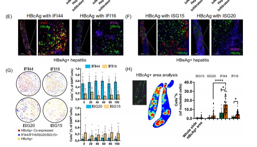 Absin多重荧光免疫组化技术助力慢性乙型肝炎的研究