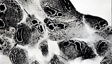 解读人巨细胞病毒
