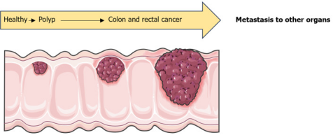 疾病专题丨结直肠癌生物标志物有哪些？一文盘点