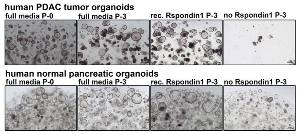人类健康胰腺类器官与胰腺导管腺癌PDAC肿瘤类器官比较