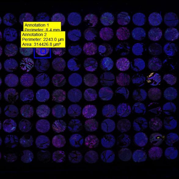 三阴乳腺癌及正常组织组合芯片