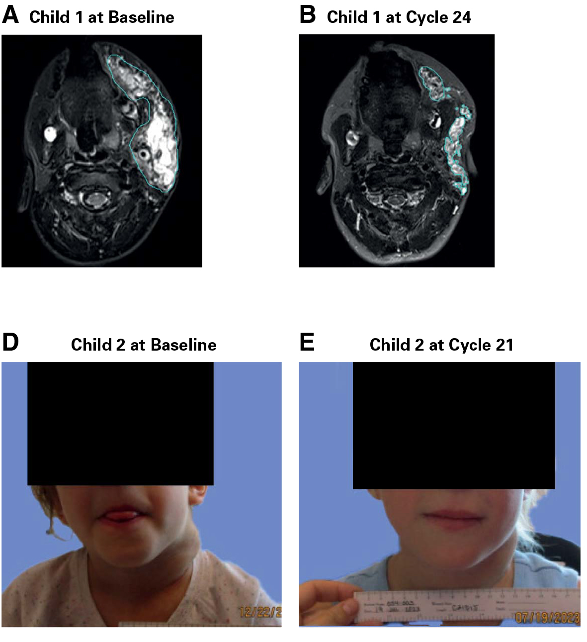 2025年FDA获批上市的激酶抑制剂会花落谁家呢？