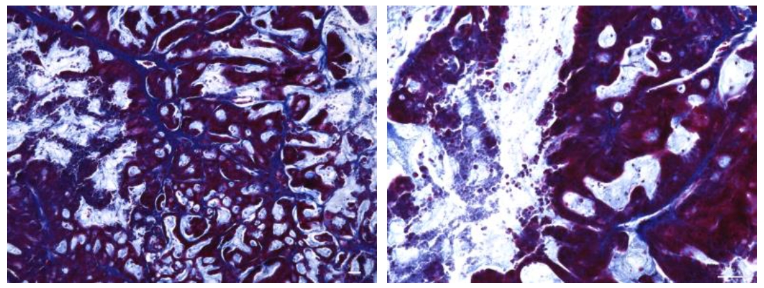 使用MatriMix进行癌症患者来源细胞的小鼠皮下移植实验