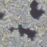 NCI-H660人神经内分泌前列腺癌细胞