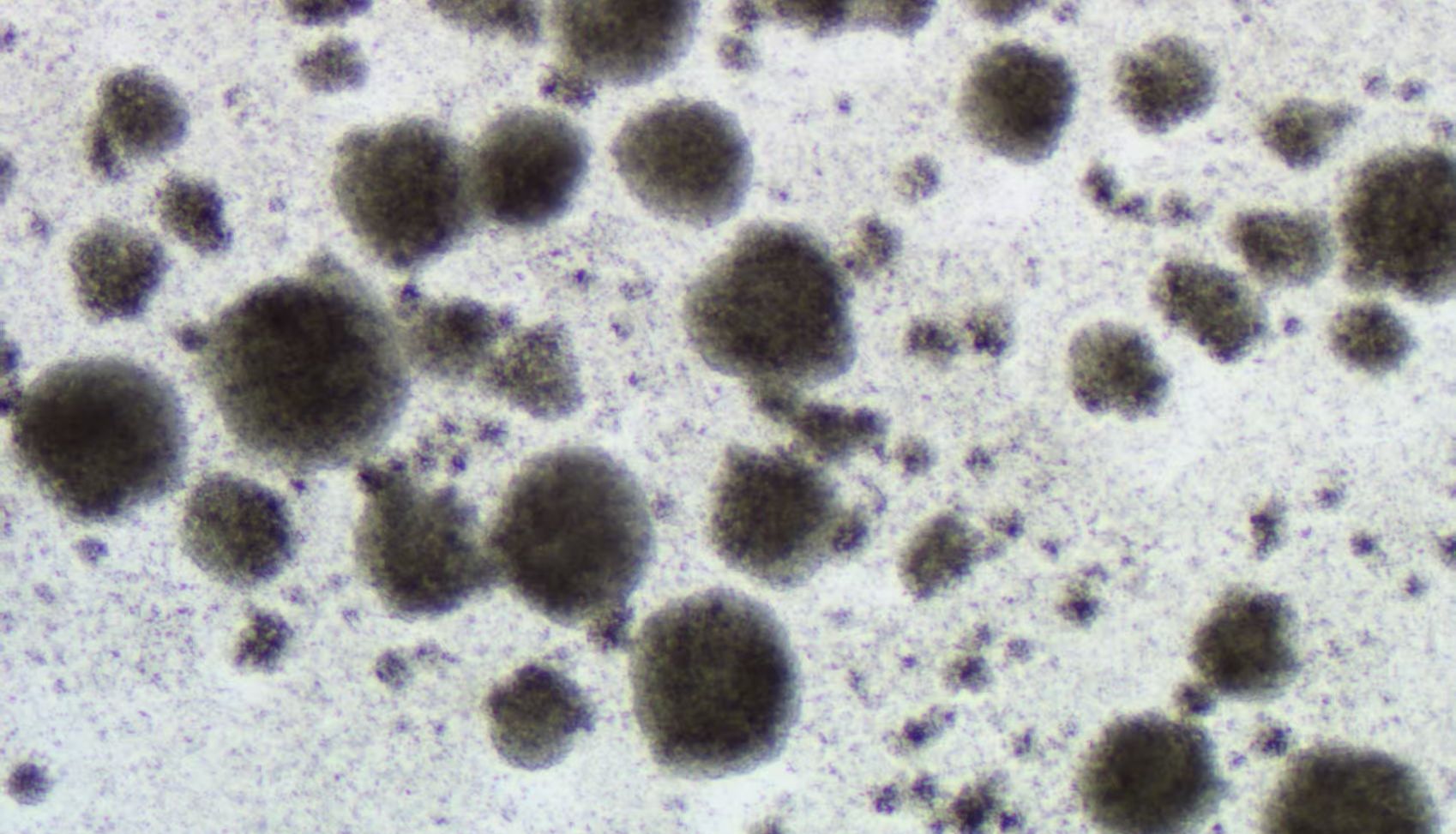 TILs（肿瘤浸润淋巴细胞）提取培养全攻略