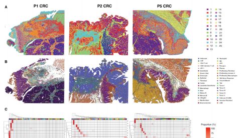 Visium HD 文章（直面分辨率提升的优势）：单细胞联合空间技术助力结直肠癌研究