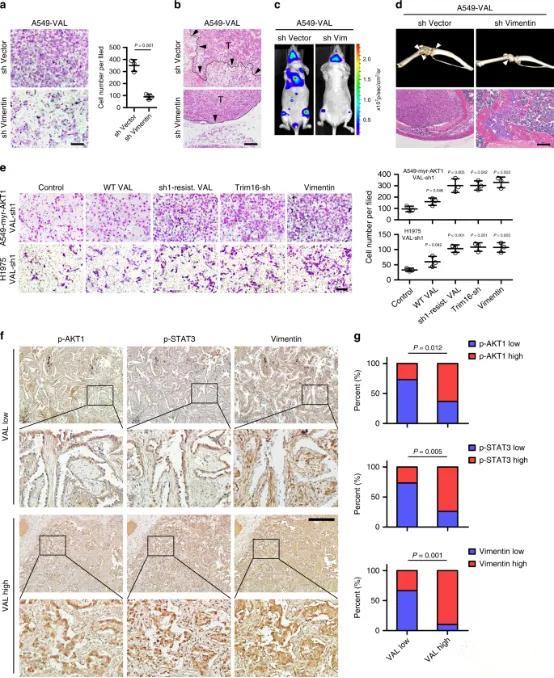 VAL通过Vimentin促进肺癌转移