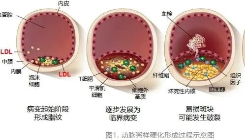 ApoE敲除小鼠制作动脉粥样硬化模型｜鼠来宝生物