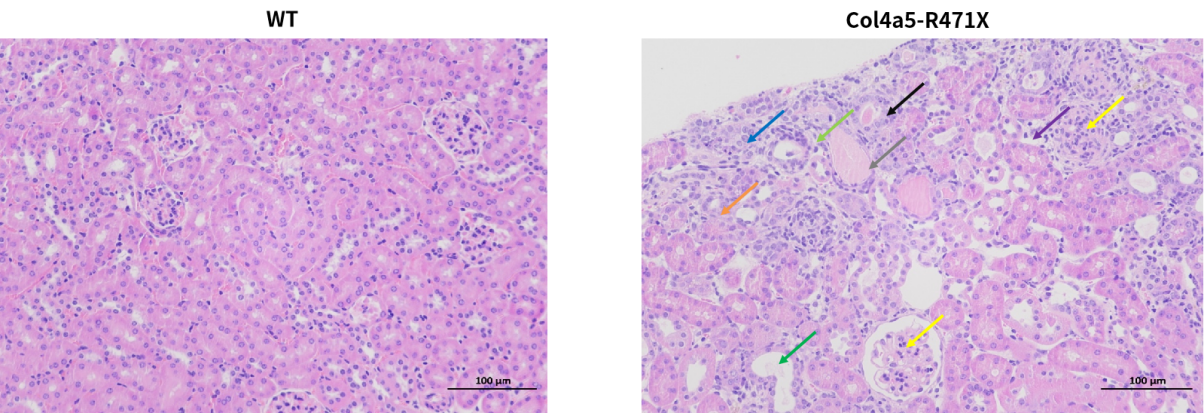 慢性肾病中的隐匿杀手——Alport综合征