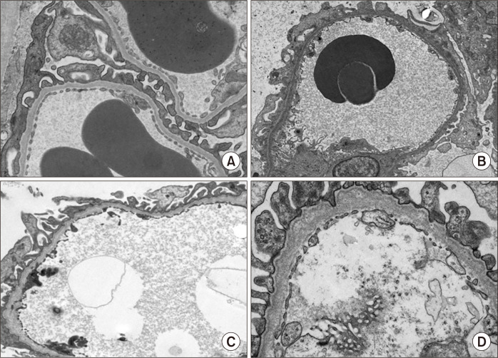 慢性肾病中的隐匿杀手——Alport综合征