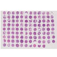 F106Ur01 子宫内膜癌StageI-IV期芯片