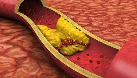 干货：动脉粥样硬化模型的建立方法