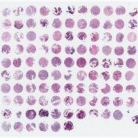 鼻咽癌组织芯片 150例