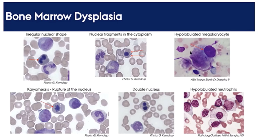 AI加持Amnis®成像流式系统，辅助MDS诊断的强大帮手！