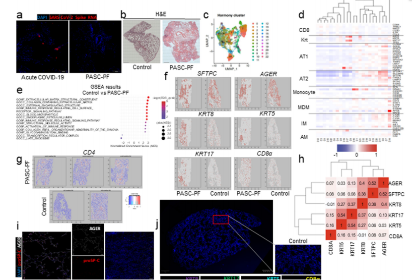 Nature文章 | 空间转录组技术助力揭示驱动病毒性肺炎后遗症“肺纤维化”的关键机制