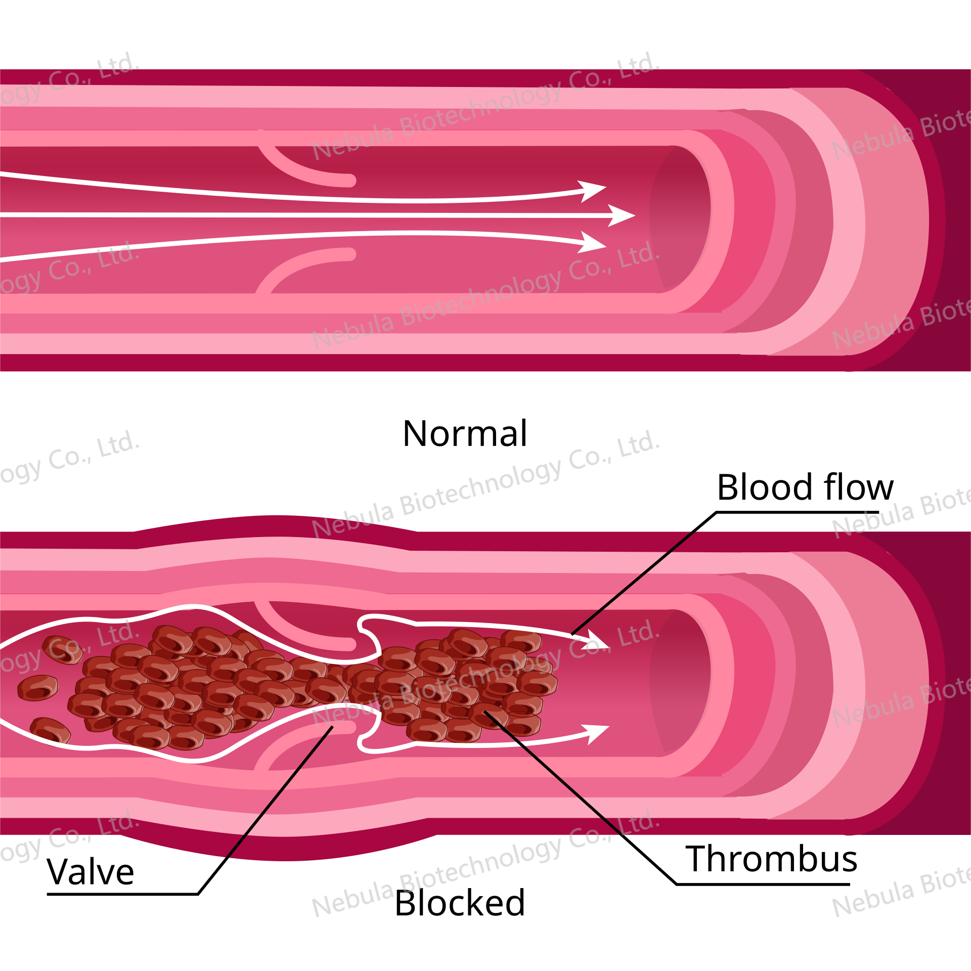 诊断原料讲堂之九：血栓生物标志物
