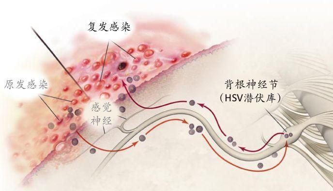 「DIFF+」精准模拟病毒“潜伏-复发”全周期｜HSV-2豚鼠感染-复发模型