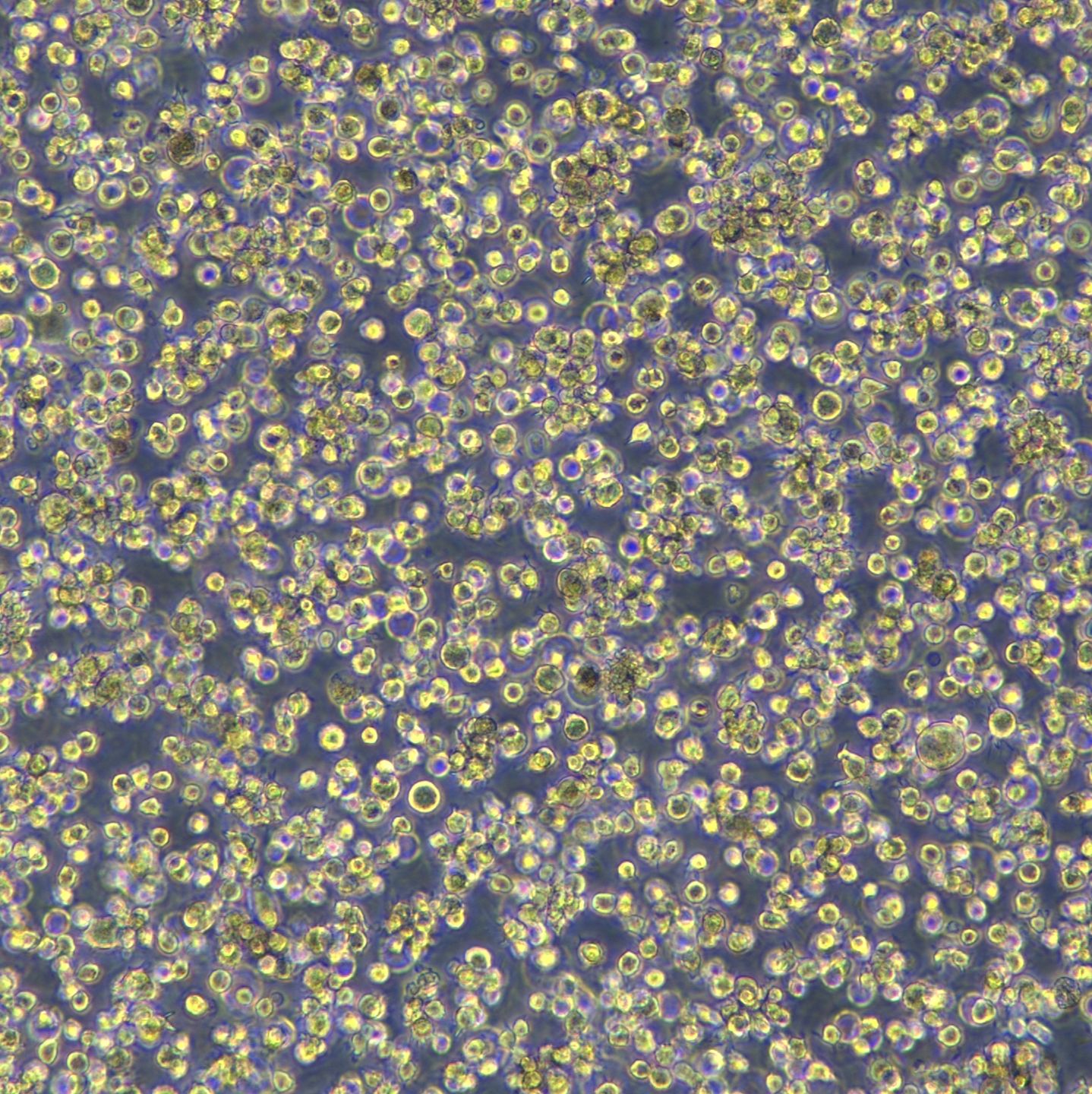 霍奇金淋巴瘤L-428