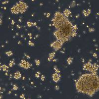 浙江美森-原发性皮肤T细胞非霍奇金淋巴瘤 MJ