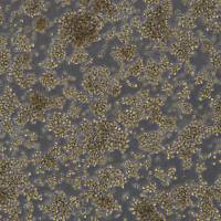 大细胞淋巴瘤 DL-40