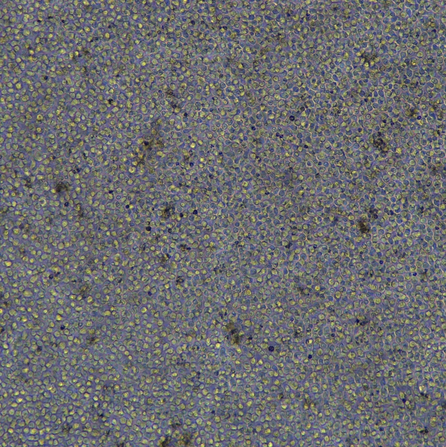 弥漫大B细胞淋巴瘤 SU-DHL-4