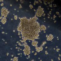 弥漫大B细胞淋巴瘤 rck8