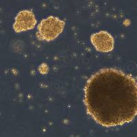 原发性中枢神经系统淋巴瘤 TK