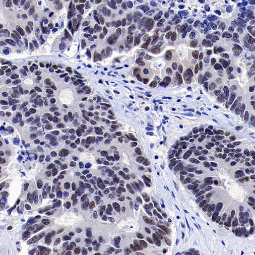 肿瘤病理靶点：MLH1和NaPi2b/SLC34A2解析