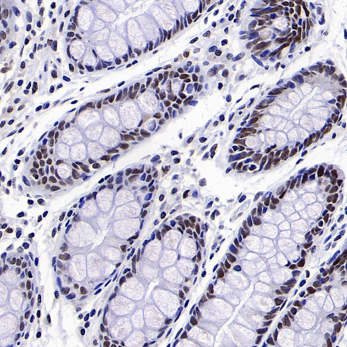 肿瘤病理靶点：MLH1和NaPi2b/SLC34A2解析