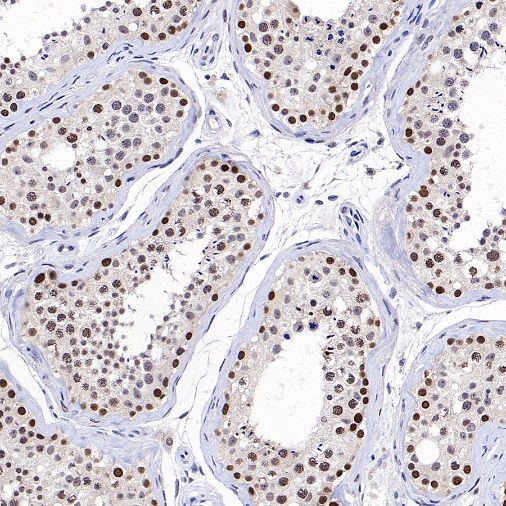 肿瘤病理靶点：MLH1和NaPi2b/SLC34A2解析