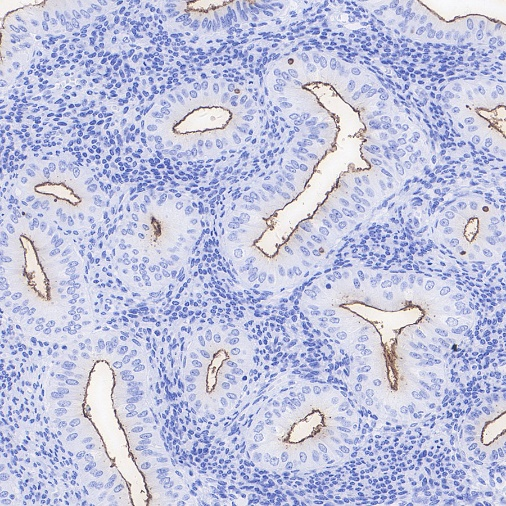 肿瘤病理靶点：MLH1和NaPi2b/SLC34A2解析
