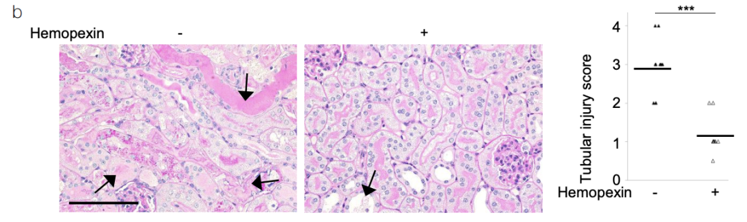 《Nature Medicine》重磅突破:巨噬细胞外陷阱与血小板激活驱动肌溶解肾损伤,揭示治疗新靶点