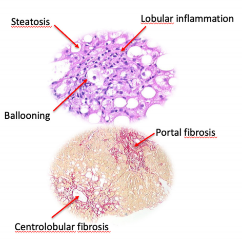 原代肝细胞-代谢功能障碍相关脂肪性肝炎(MASH)研究的核心模型