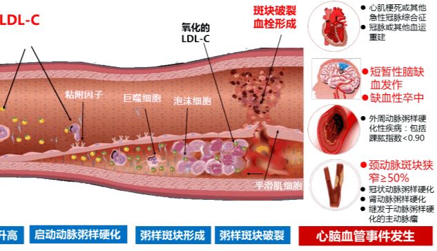 三步构建动脉粥样硬化细胞模型：ox-LDL诱导损伤/泡沫/钙化全攻略