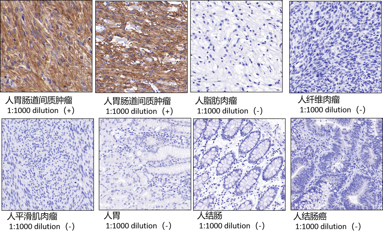 跟着斯达特学病理靶点:胃肠道间质肿瘤诊断指标DOG1/TMEM16A