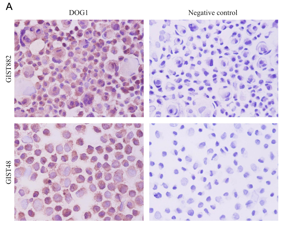 跟着斯达特学病理靶点:胃肠道间质肿瘤诊断指标DOG1/TMEM16A