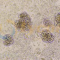 人恶性非霍奇金淋巴瘤患者的自然杀伤细胞；NK-92(STR)