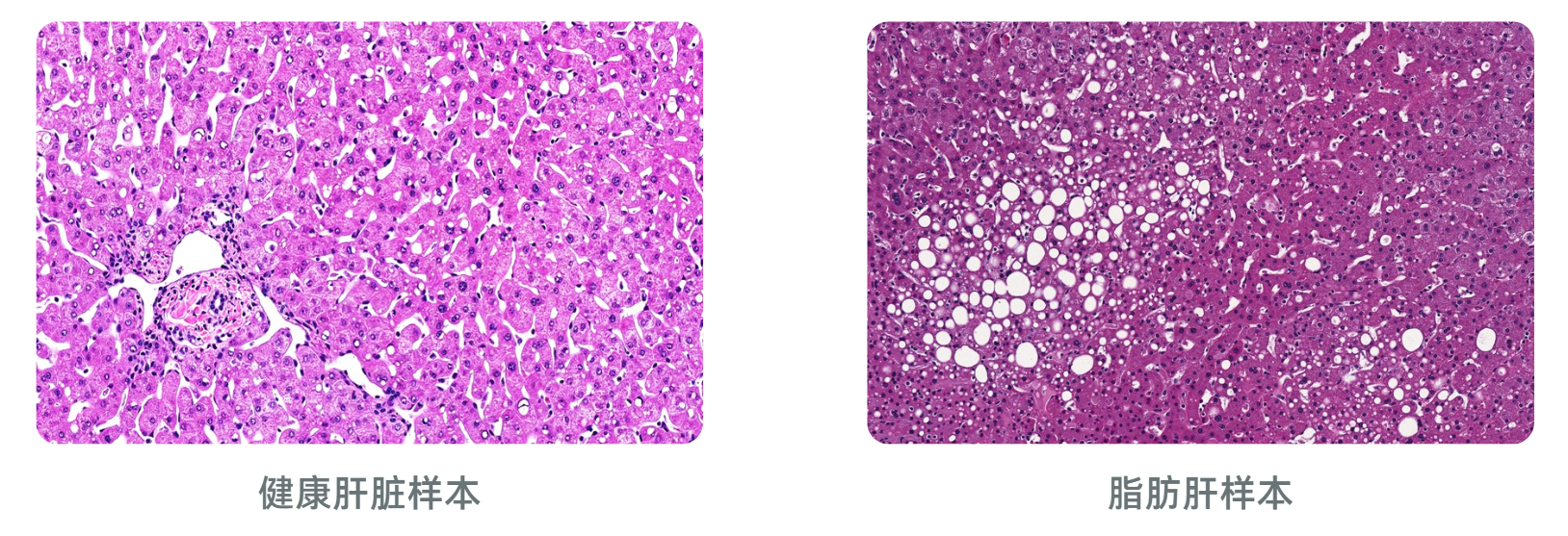 LifeNet Health提供一系列非酒精性脂肪肝/非酒精性脂肪性肝炎捐赠者的人肝组织