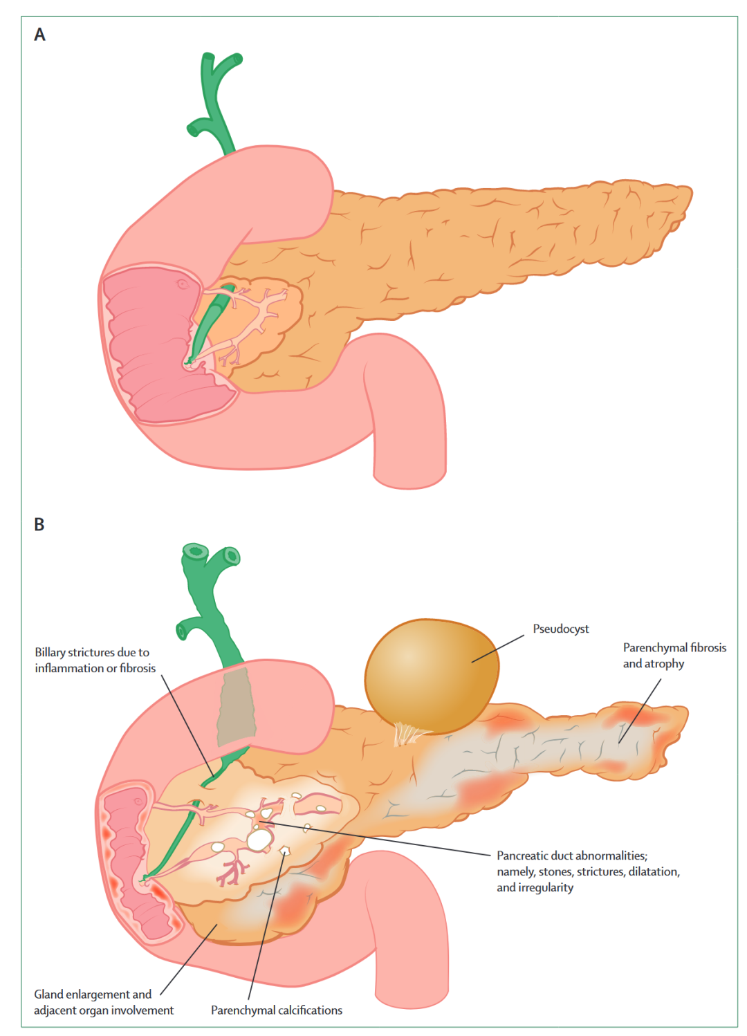 消化赛道再加速！南模生物慢性胰腺炎模型，让药效评价快人一步