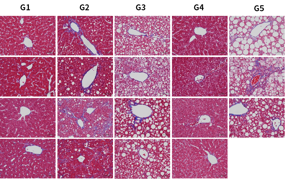 PNPLA3：MASLD/MASH明星靶点的下一站机会