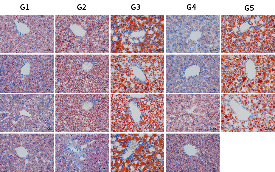 PNPLA3：MASLD/MASH明星靶点的下一站机会