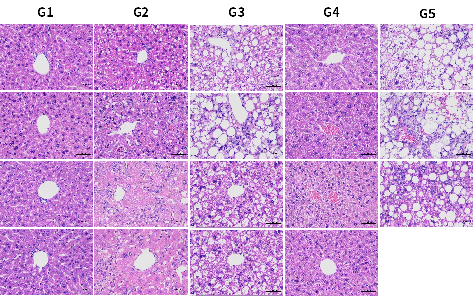 PNPLA3：MASLD/MASH明星靶点的下一站机会