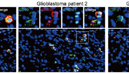【IF 44.5】突破胶质母细胞瘤研究瓶颈：揭示浆细胞与肿瘤干细胞的关键关联