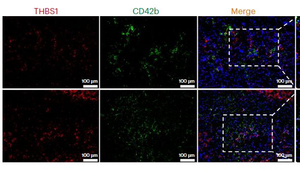 【IF 50】突破异种移植免疫研究壁垒，揭示猪-人肝移植免疫细胞动态