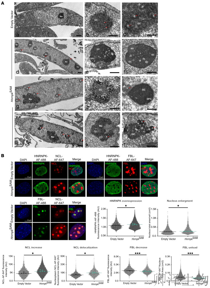 【核糖体疾病】 | 肿瘤抑制因子“黑化”记：过量HNRNPK如何引爆细胞核仁，诱发罕见血液病