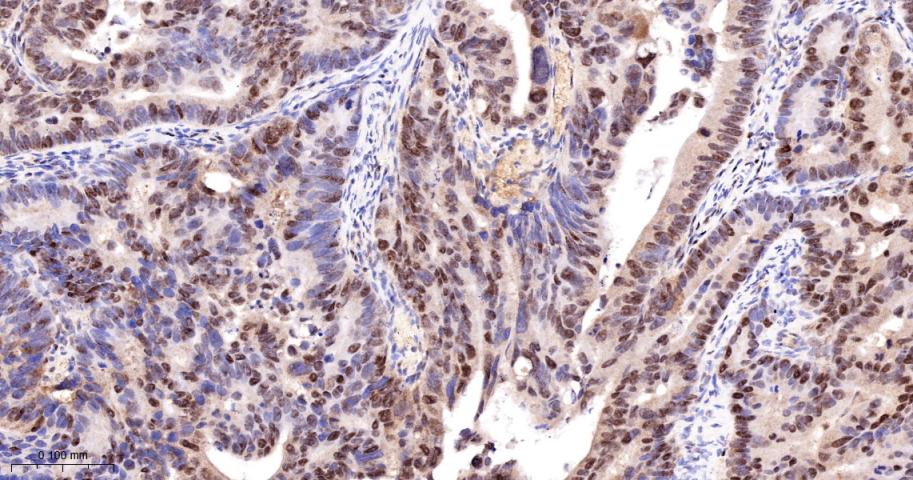 Cleaved PARP1 p25 Recombinant 